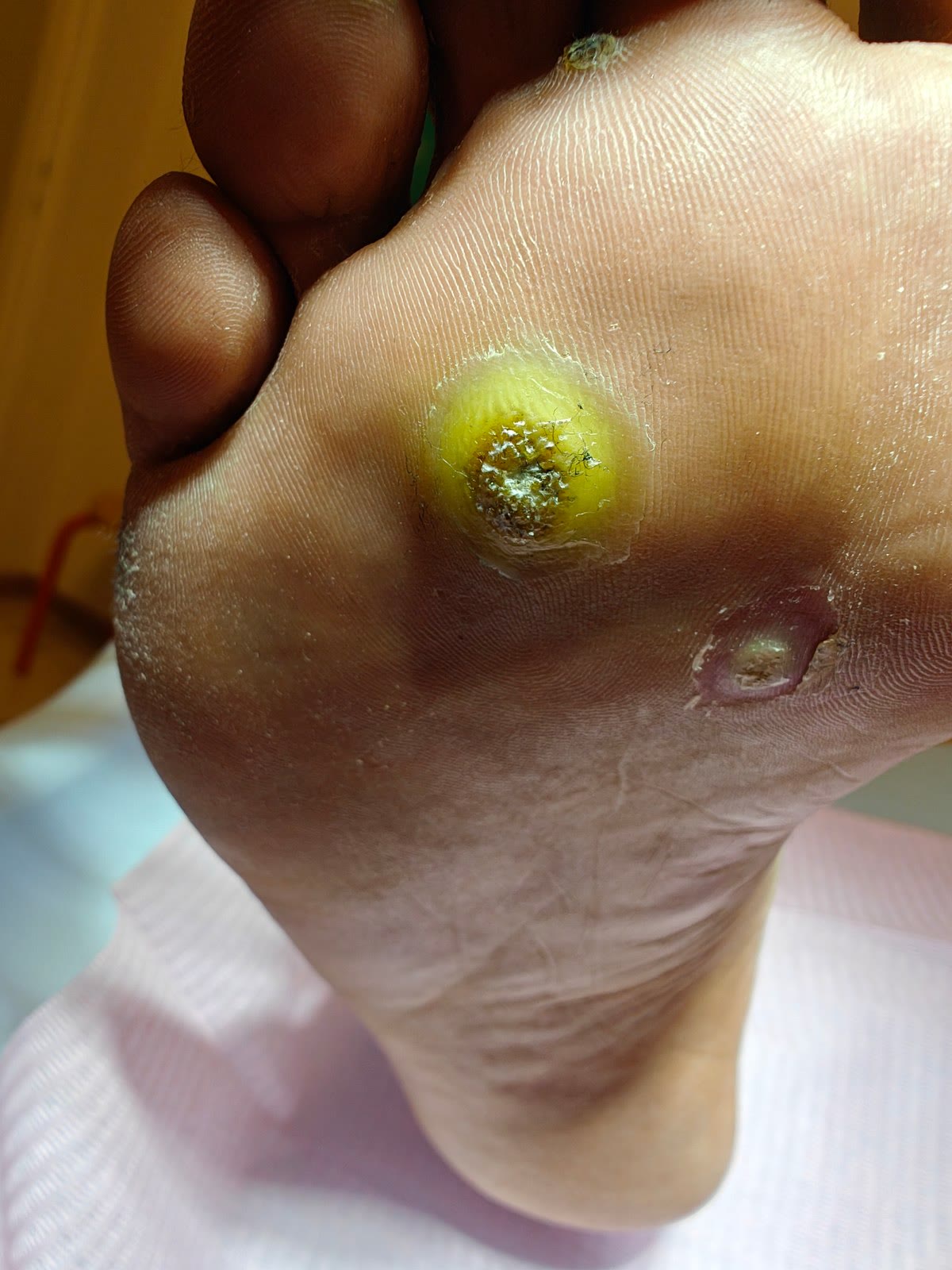 Una verruca plantare durante un trattamento topico, con la medicazione in sede
